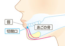 口の穴の中を切開