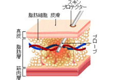 脂肪吸引