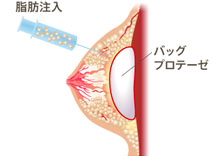 バストへバッグ挿入・脂肪注入