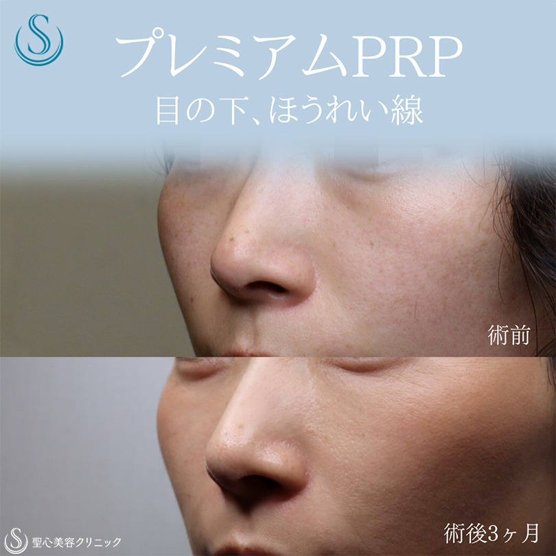 【30代女性・目の下、ほうれい線をナチュラルに目立たなく】プレミアムPRP皮膚再生療法（術後3ヶ月） After 
