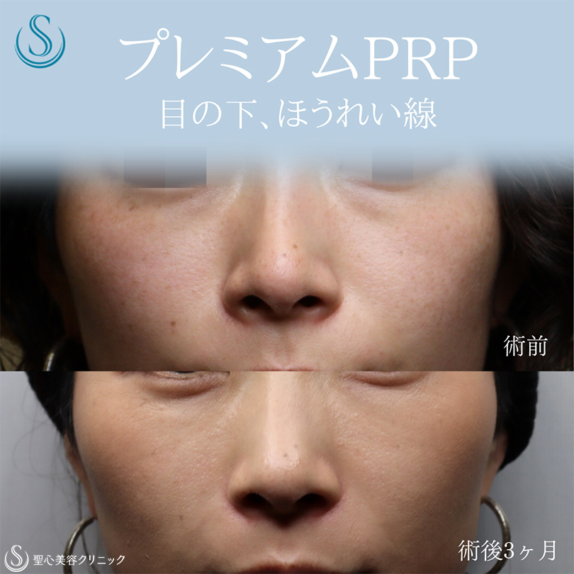 【30代女性・目の下、ほうれい線をナチュラルに目立たなく】プレミアムPRP皮膚再生療法（術後3ヶ月） Before 