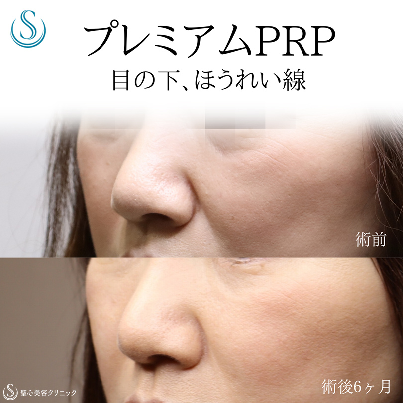 【50代女性・目の下、ほうれい線を目立ちにくく】プレミアムPRP皮膚再生療法（術後6ヶ月） After 