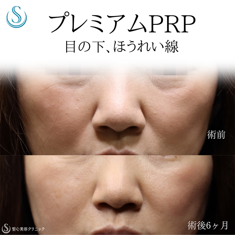 【50代女性・目の下、ほうれい線を目立ちにくく】プレミアムPRP皮膚再生療法（術後6ヶ月） Before 