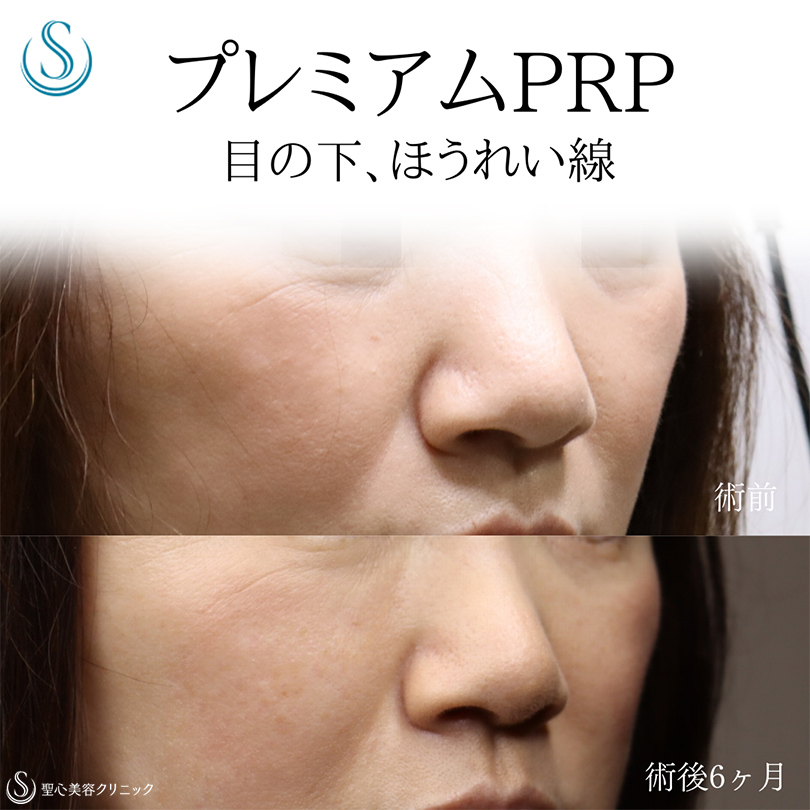 【50代女性・目の下、ほうれい線を目立ちにくく】プレミアムPRP皮膚再生療法（術後6ヶ月） After 