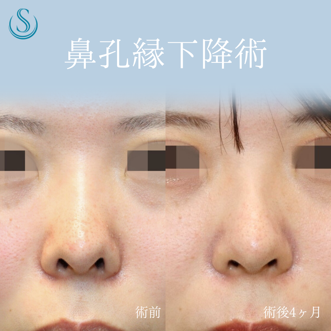 【20代女性・鼻の穴を目立ちにくく】鼻孔縁下降術（術後4ヶ月） Before 