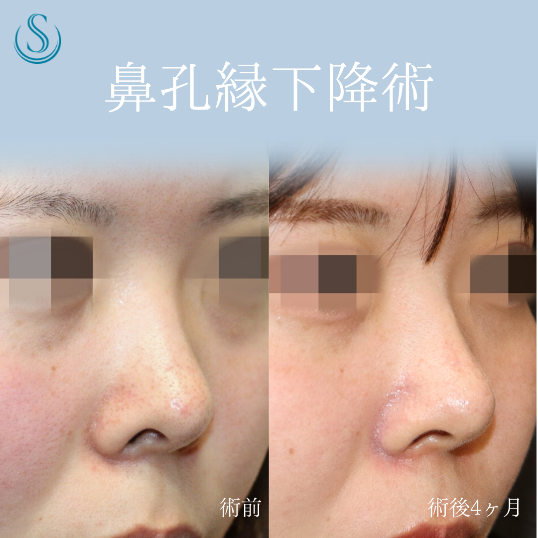【20代女性・鼻の穴を目立ちにくく】鼻孔縁下降術（術後4ヶ月） After 