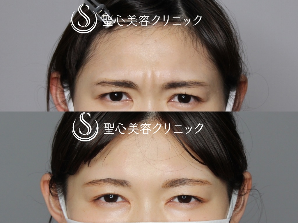 【20代女性・眉間の表情ジワが目立ちにくく】眉間ボトックス（スタッフ処置）（10日後） After 