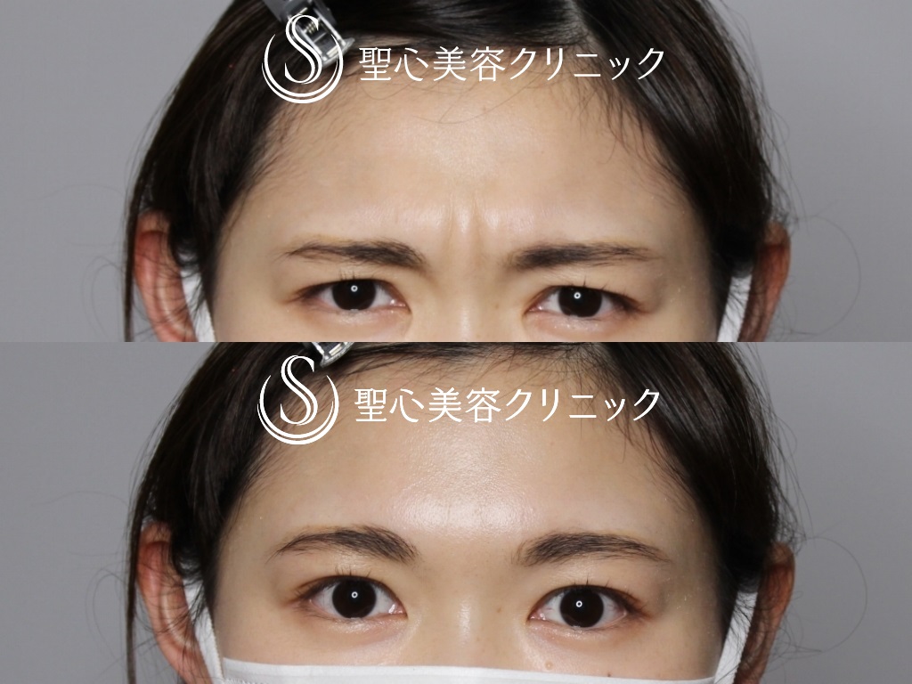 【20代女性・眉間の表情ジワが目立ちにくく】眉間ボトックス（スタッフ処置）（10日後） Before 