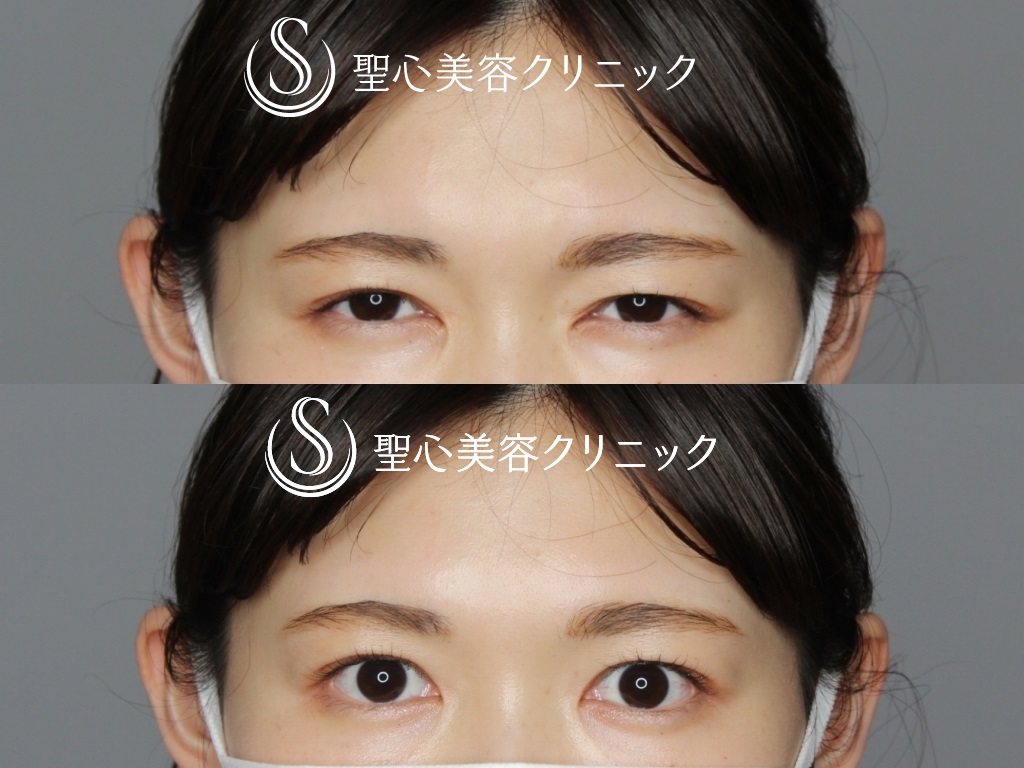 【20代女性・眉間の表情ジワが目立ちにくく】眉間ボトックス（スタッフ処置）（10日後） After 