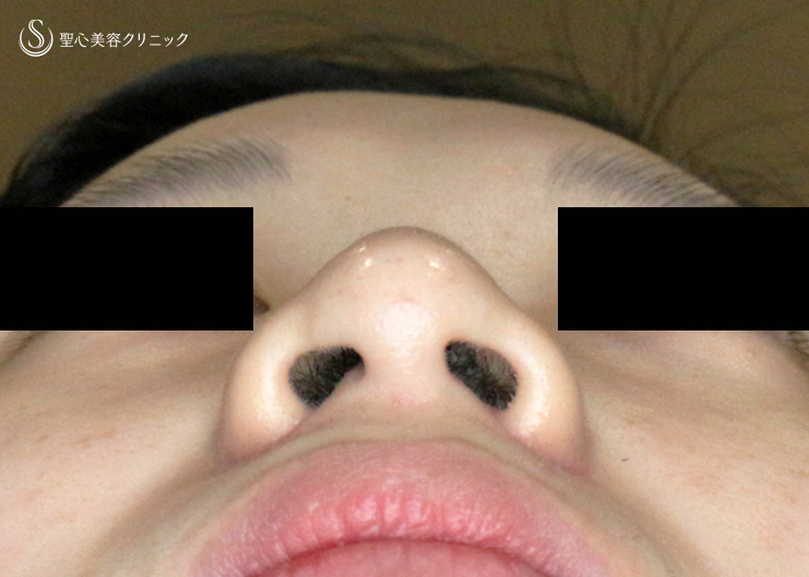 【20代女性・鼻孔が小さいケースへの対応拡大】小鼻縮小術+α法「Ver.6」（術直後〜2ヶ月後） After 