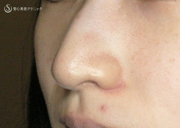 【20代女性・鼻孔が小さいケースへの対応拡大】小鼻縮小術+α法「Ver.6」（術直後〜2ヶ月後） After 