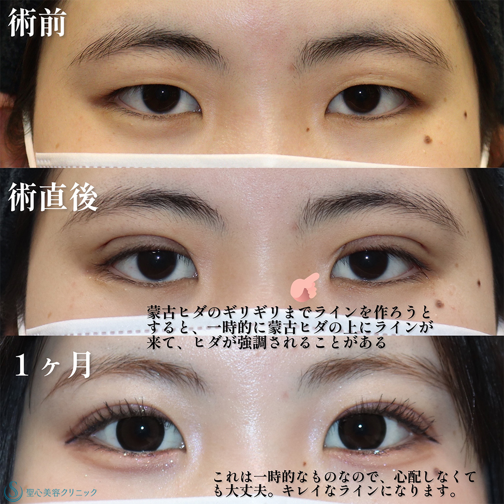 【20代女性・埋没法で目を大きく華やかに】二重術（埋没法）：マイクロメソッド+α（1ヶ月後） Before 