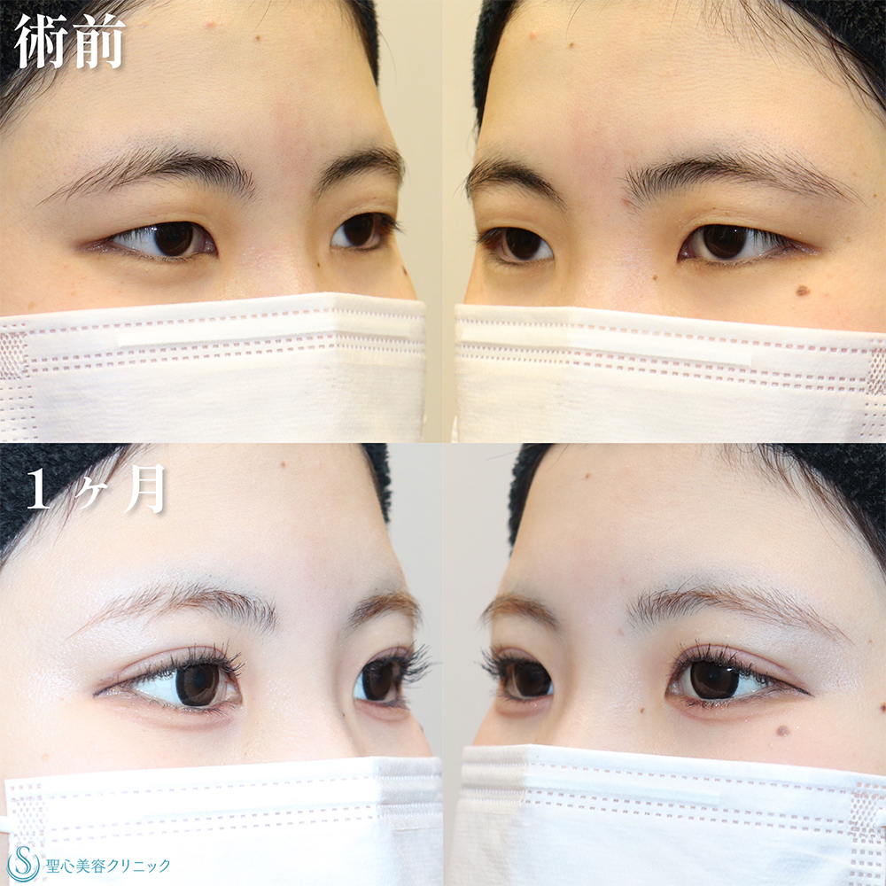 【20代女性・埋没法で目を大きく華やかに】二重術（埋没法）：マイクロメソッド+α（1ヶ月後） After 
