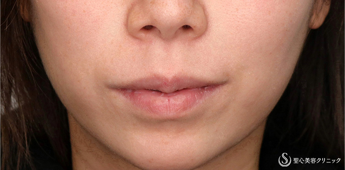 【30代女性・人中をできるだけ短くしたい！！】プレミアムリップリフト（プレミアム人中短縮術）（術後1ヶ月） Before 