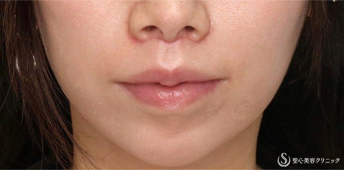 【30代女性・人中をできるだけ短くしたい！！】プレミアムリップリフト（プレミアム人中短縮術）（術後1ヶ月） After 