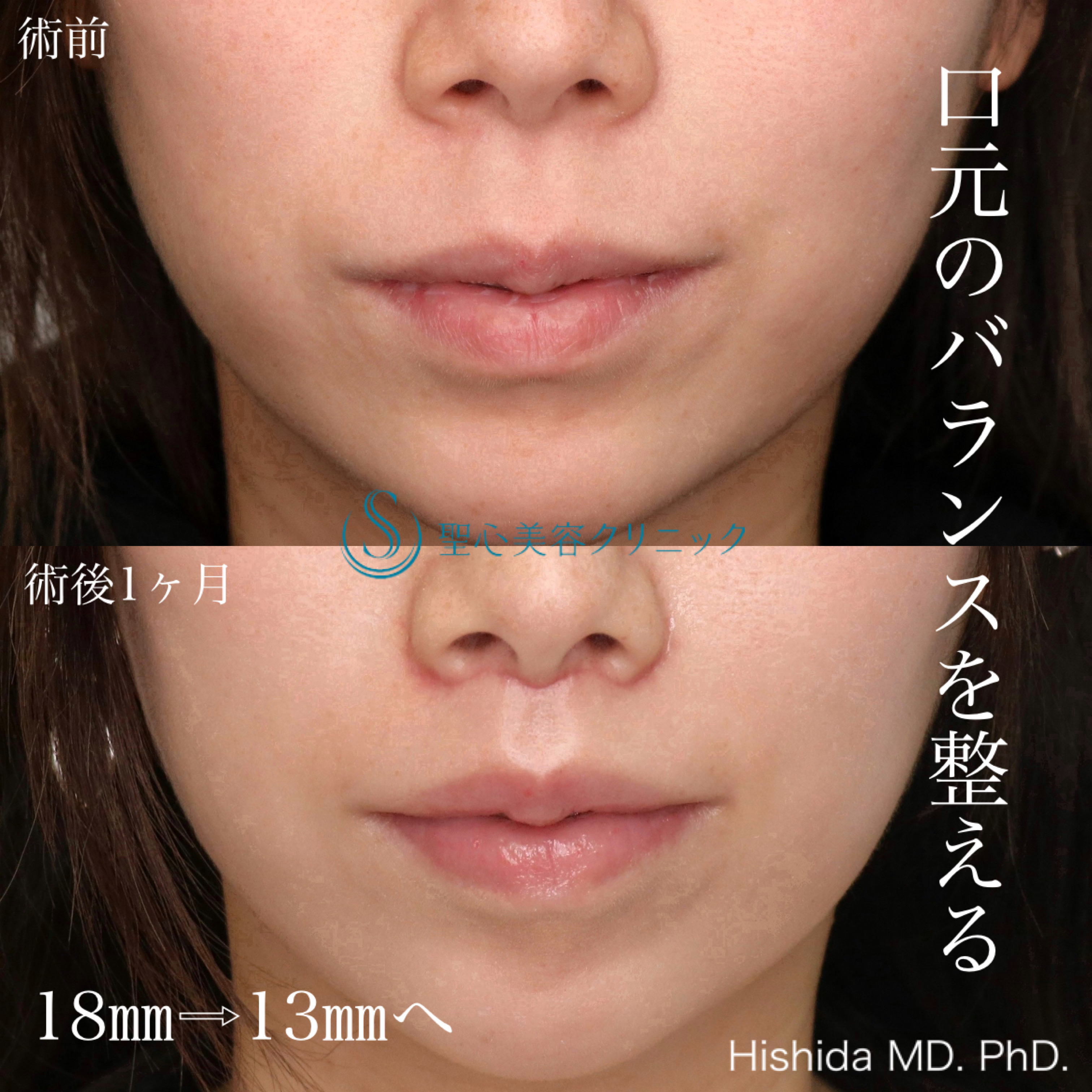 【30代女性・人中をできるだけ短くしたい！！】プレミアムリップリフト（プレミアム人中短縮術）（術後1ヶ月） After 