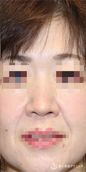 【40代女性・厚いお鼻をスッキリ・鼻の穴も目立たなく】鼻中隔延長術（肋軟骨）＋鼻尖形成（肋軟骨）＋鼻背形成（肋軟骨）（術後6ヶ月） After 