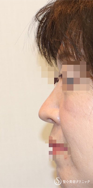 【40代女性・厚いお鼻をスッキリ・鼻の穴も目立たなく】鼻中隔延長術（肋軟骨）＋鼻尖形成（肋軟骨）＋鼻背形成（肋軟骨）（術後6ヶ月） After 