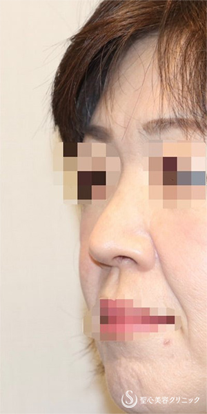 【40代女性・厚いお鼻をスッキリ・鼻の穴も目立たなく】鼻中隔延長術（肋軟骨）＋鼻尖形成（肋軟骨）＋鼻背形成（肋軟骨）（術後6ヶ月） After 