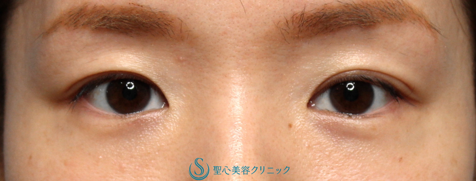 【30代女性・眼力のあるバランスの良い二重にしたい】二重マイクロメソッド埋没法（3点）＋目頭切開（3か月後） Before 