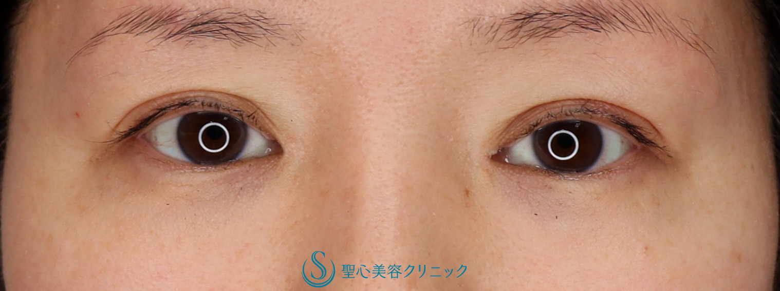 【30代女性・眼力のあるバランスの良い二重にしたい】二重マイクロメソッド埋没法（3点）＋目頭切開（3か月後） After 
