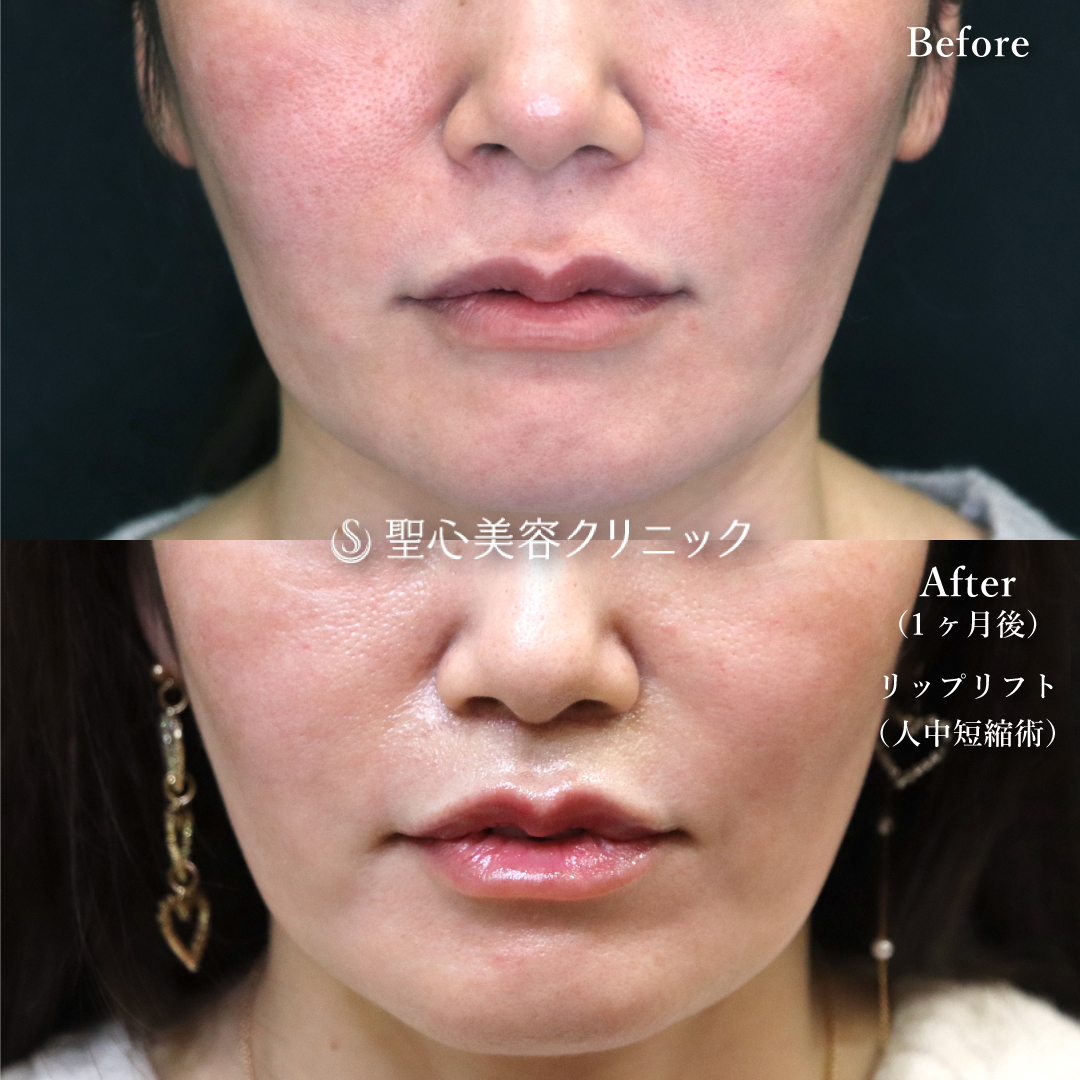 【40代女性・唇を引き上げて若々しく】リップリフト（１ヶ月後） Before 