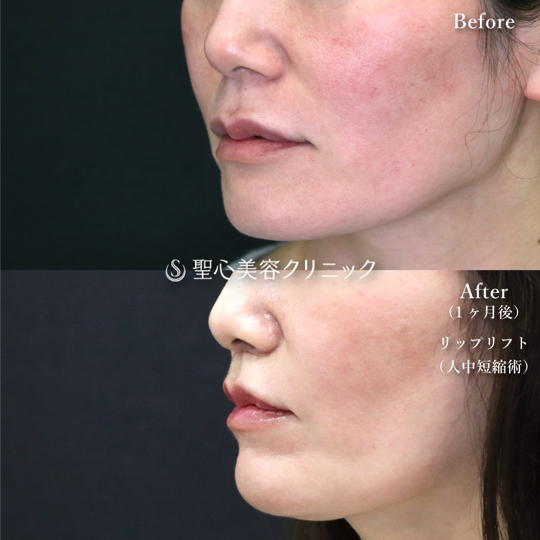 【40代女性・唇を引き上げて若々しく】リップリフト（１ヶ月後） After 