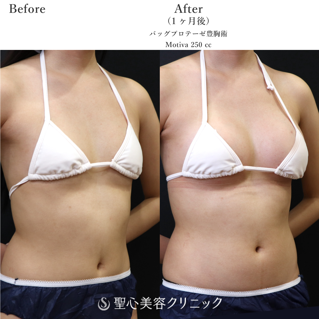 【20代女性・自然にお胸を大きく】豊胸　モティバ　250cc（1ヶ月後） After 
