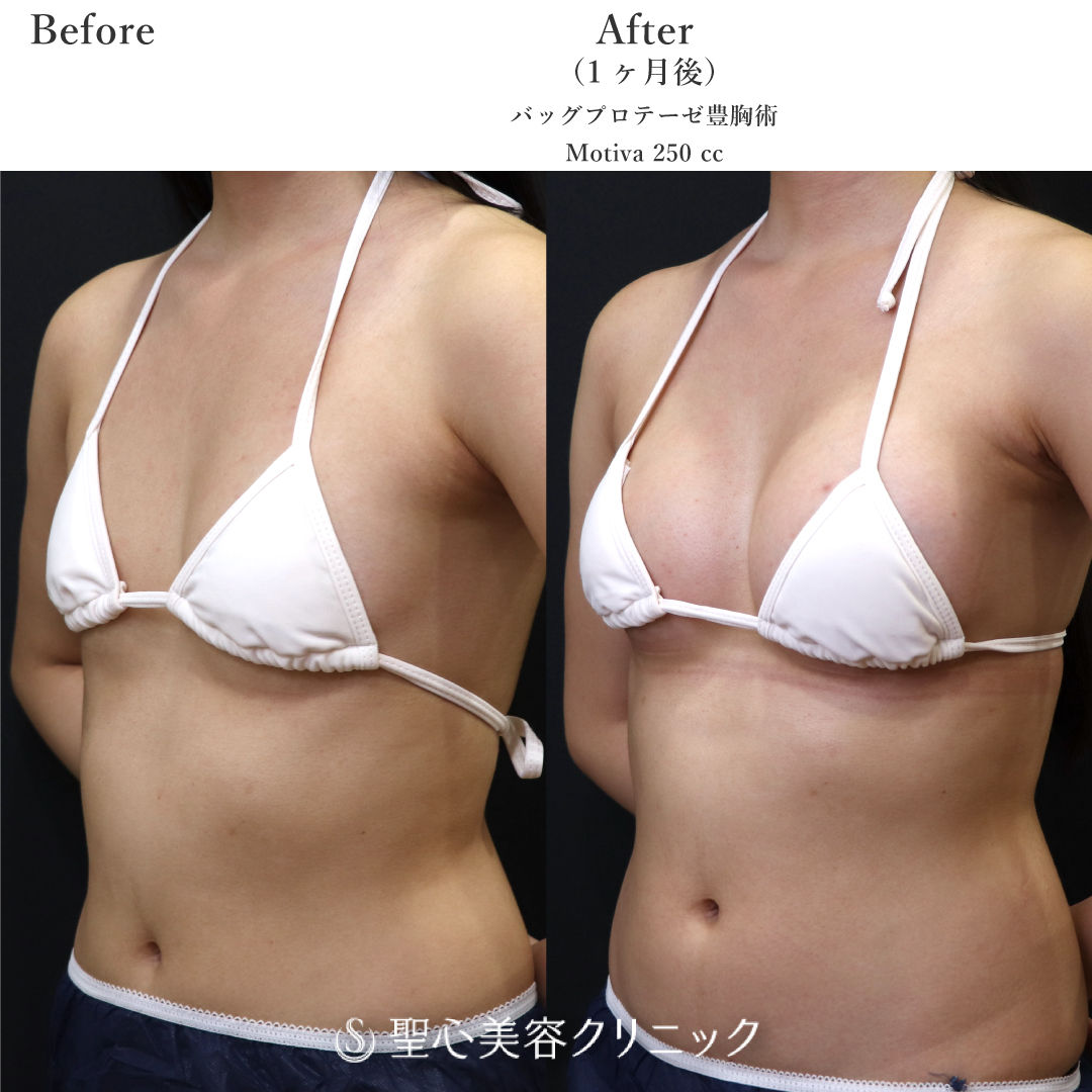 【20代女性・自然にお胸を大きく】豊胸　モティバ　250cc（1ヶ月後） After 