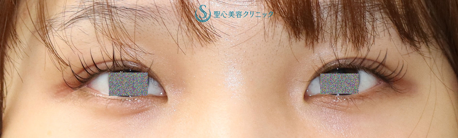 【20代女性・蒙古ひだを除去して目力のある平行二重に】目頭切開（1年4か月後） Before 