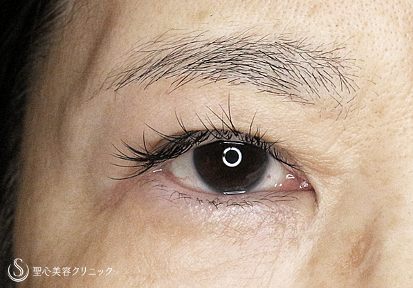 【50代女性・まぶたのタルミを取り昔の目元に戻す】2回目の眉下リフト（3年後） After 