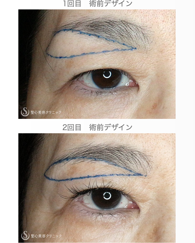 【50代女性・まぶたのタルミを取り昔の目元に戻す】2回目の眉下リフト（3年後） Before 