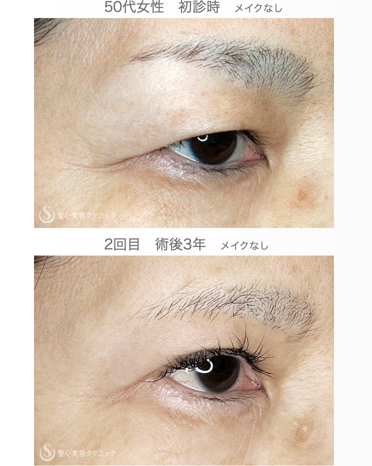 【50代女性・まぶたのタルミを取り昔の目元に戻す】2回目の眉下リフト（3年後） After 