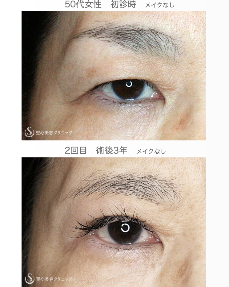 【50代女性・まぶたのタルミを取り昔の目元に戻す】2回目の眉下リフト（3年後） After 