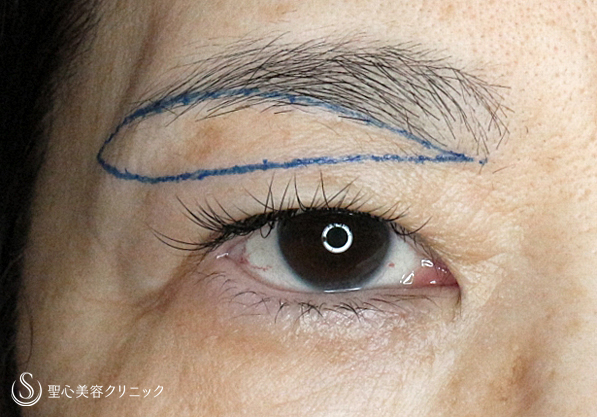 【50代女性・まぶたのタルミを取り昔の目元に戻す】2回目の眉下リフト（3年後） Before 