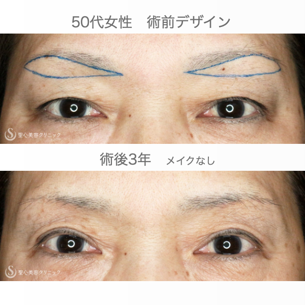 【50代女性・加齢による三角目を改善する】眉下リフト（3年後） Before 