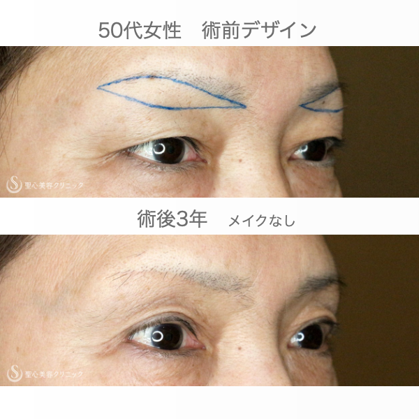 【50代女性・加齢による三角目を改善する】眉下リフト（3年後） After 