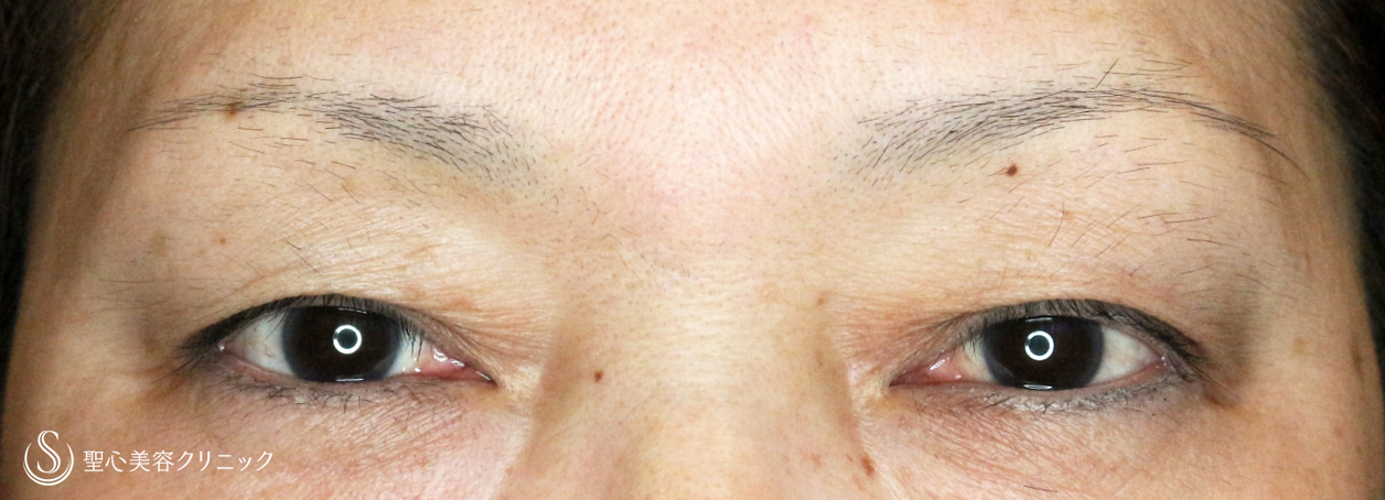 【50代女性・加齢による三角目を改善する】眉下リフト（3年後） Before 