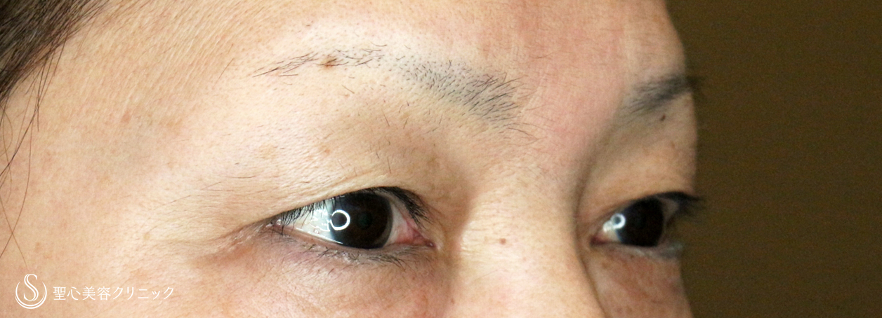 【50代女性・加齢による三角目を改善する】眉下リフト（3年後） Before 