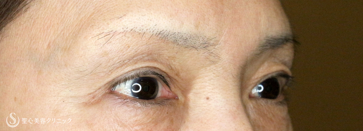 【50代女性・加齢による三角目を改善する】眉下リフト（3年後） After 
