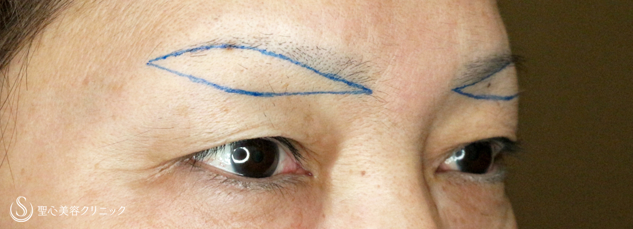【50代女性・加齢による三角目を改善する】眉下リフト（3年後） Before 