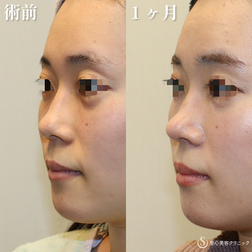 【20代女性・鼻先をナチュラルに細く高く】鼻尖縮小＋ 鼻尖形成（耳介軟骨移植）＋ストラット法（鼻柱補強術）+小鼻縮小（1か月後） After 