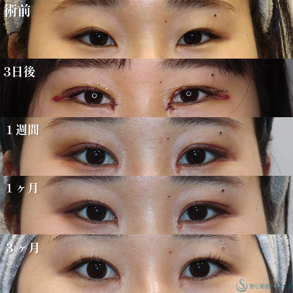【20代女性・目頭切開＋α法で一気に垢抜け】二重術（切開法）部分切開/全切開＋目頭切開/目上切開（3か月後） Before 