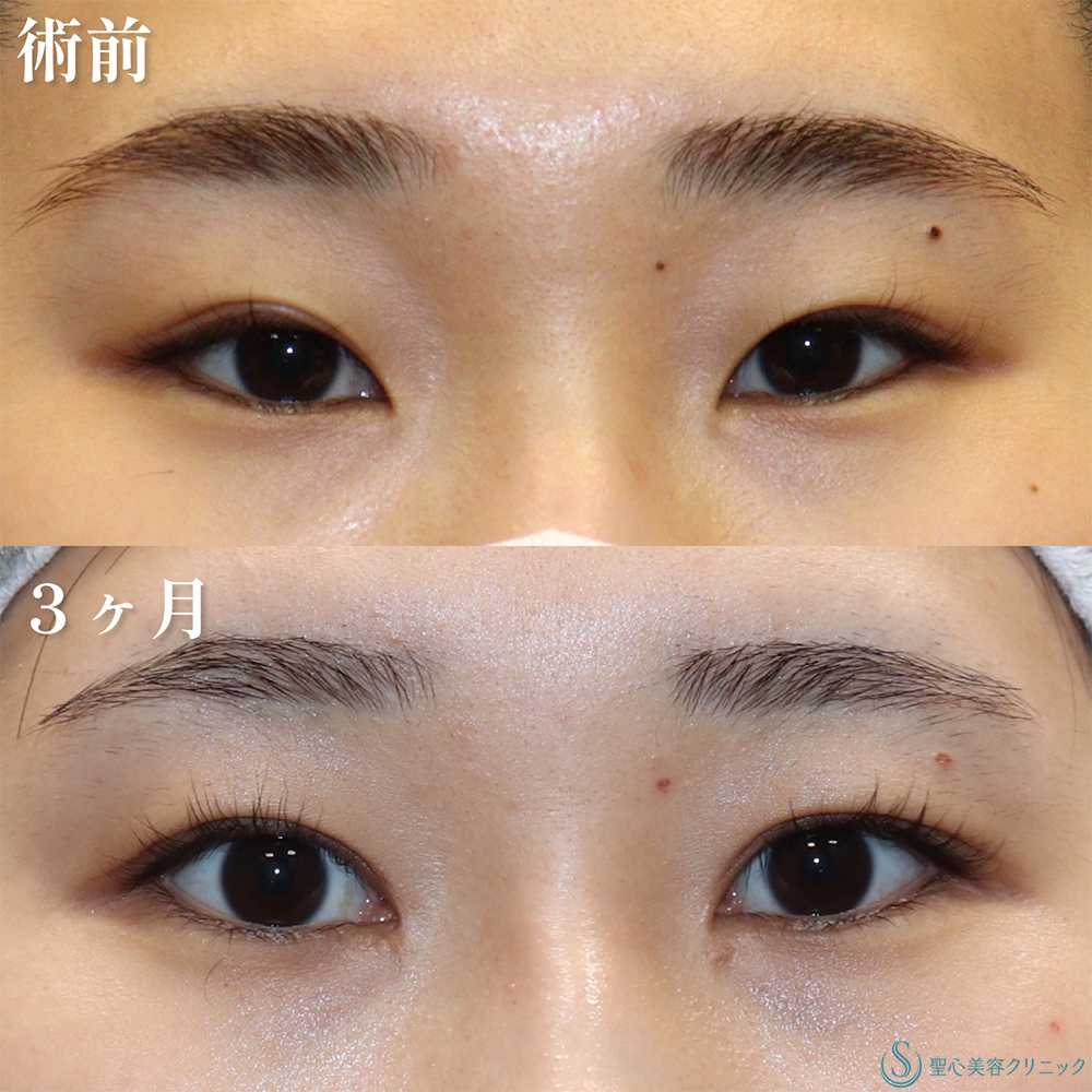 【20代女性・目頭切開＋α法で一気に垢抜け】二重術（切開法）部分切開/全切開＋目頭切開/目上切開（3か月後） After 
