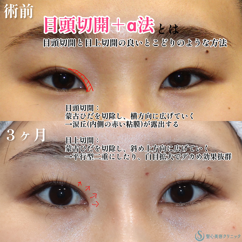 【20代女性・目頭切開＋α法で一気に垢抜け】二重術（切開法）部分切開/全切開＋目頭切開/目上切開（3か月後） Before 