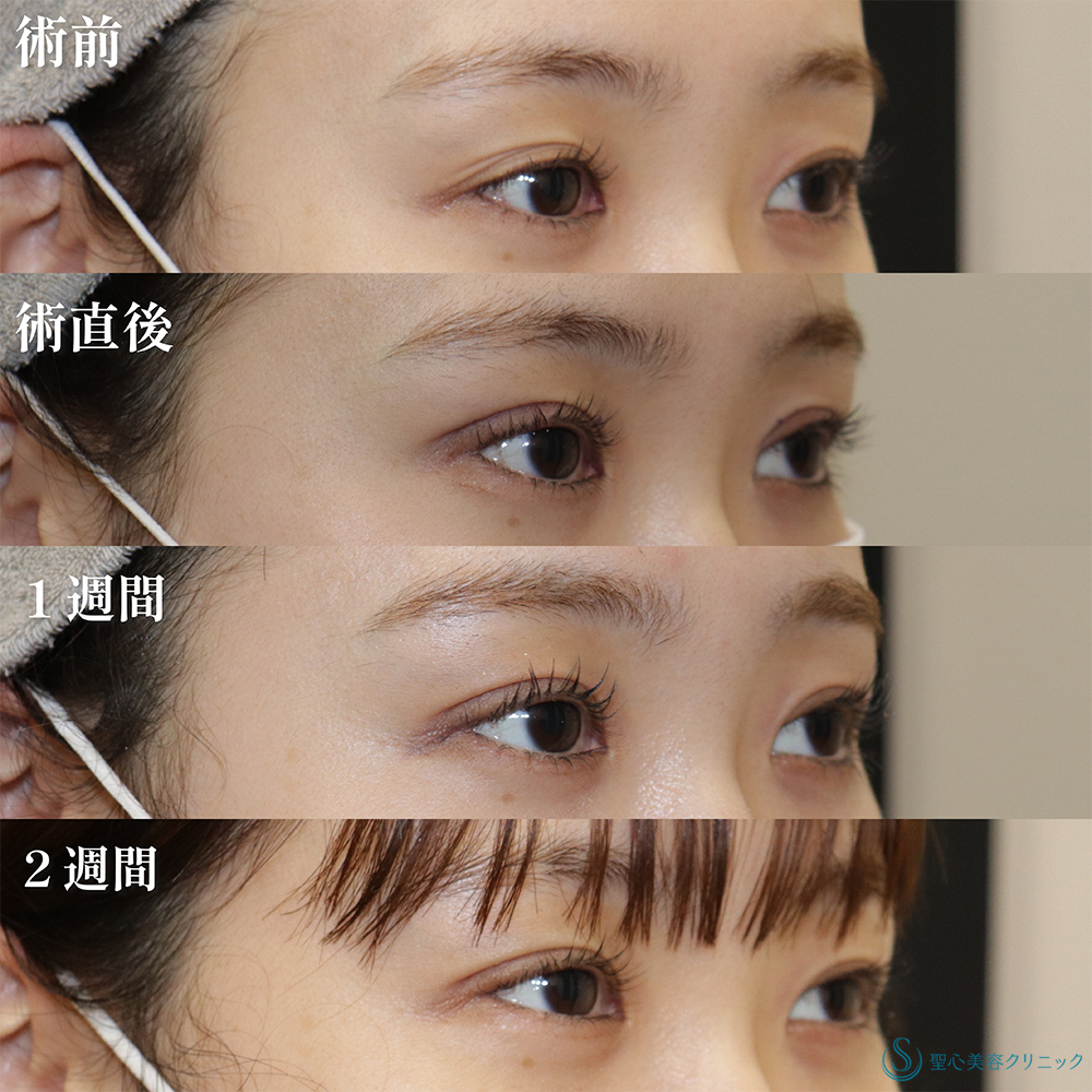 【20代女性・二重美女がさらに美しく】二重術（埋没法）：マイクロメソッド+α（2週間後） After 