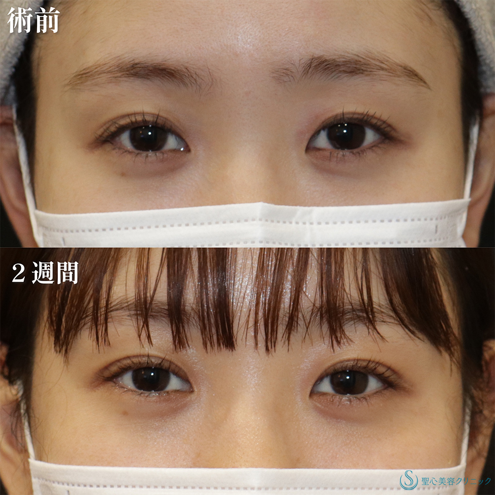 【20代女性・二重美女がさらに美しく】二重術（埋没法）：マイクロメソッド+α（2週間後） Before 