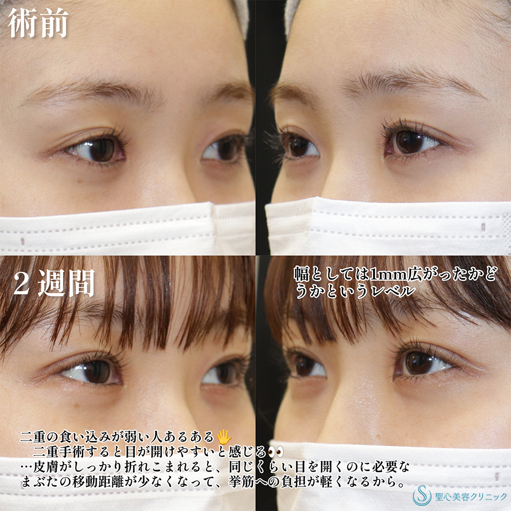 【20代女性・二重美女がさらに美しく】二重術（埋没法）：マイクロメソッド+α（2週間後） Before 