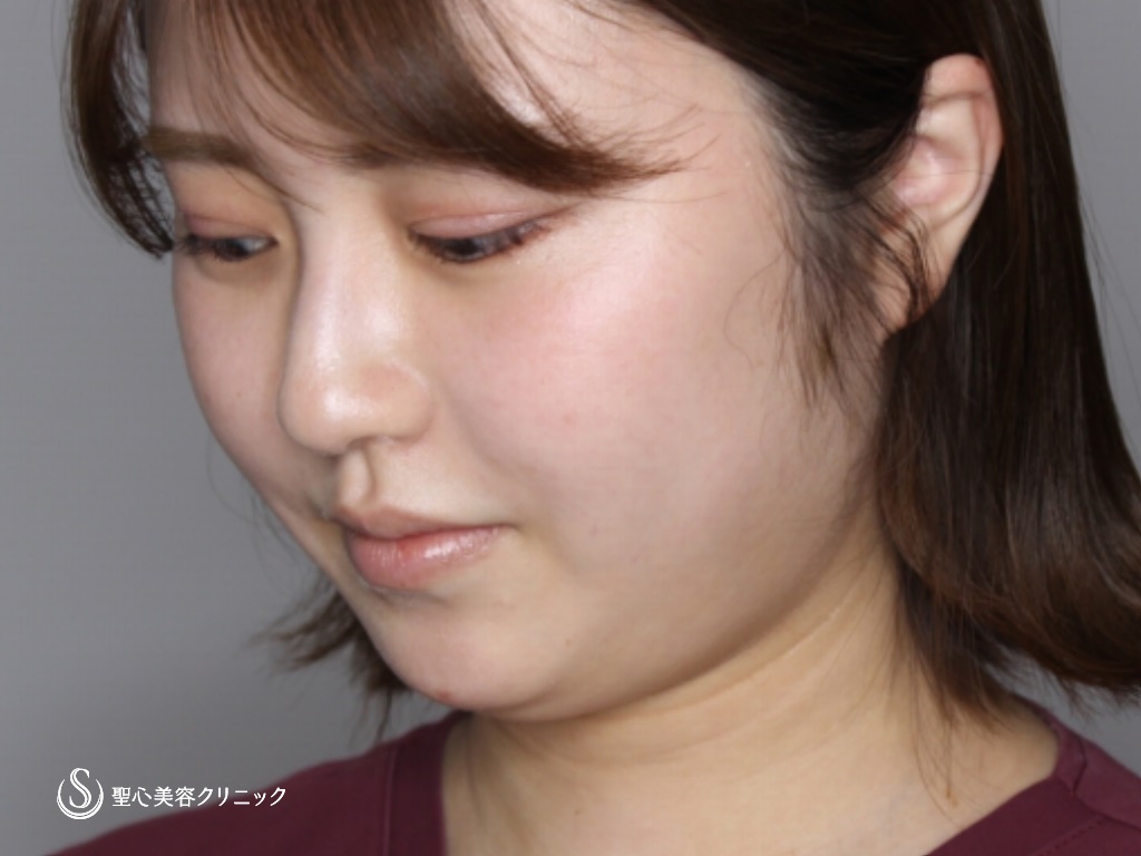 【20代女性・顎下をスッキリと】顎下ベイザー脂肪吸引（当院スタッフ）（3か月後） Before 