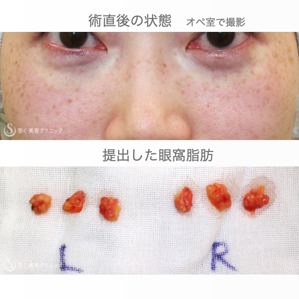 【30代女性・目の下のクマを治す（他院修正例）】経結膜下脱脂術・単独（1年8ヶ月後） Before 